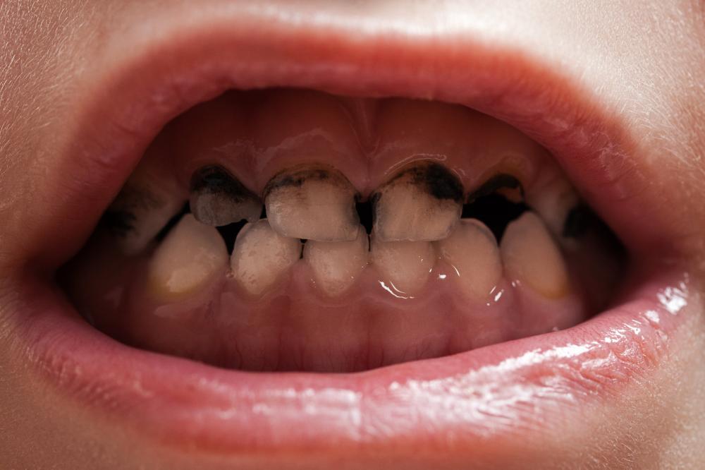 caries-teeth-decay