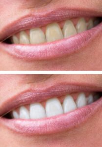 woman-teeth-before-and-after-whitening