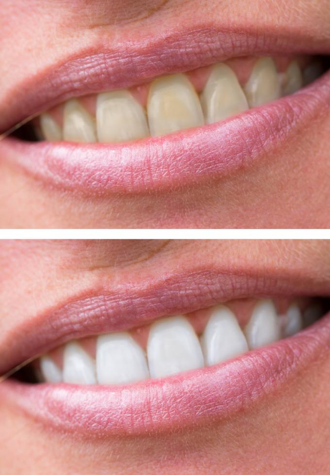 woman-teeth-before-and-after-whitening
