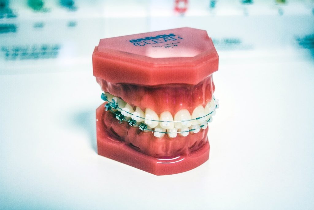 A model of teeth with braces. 