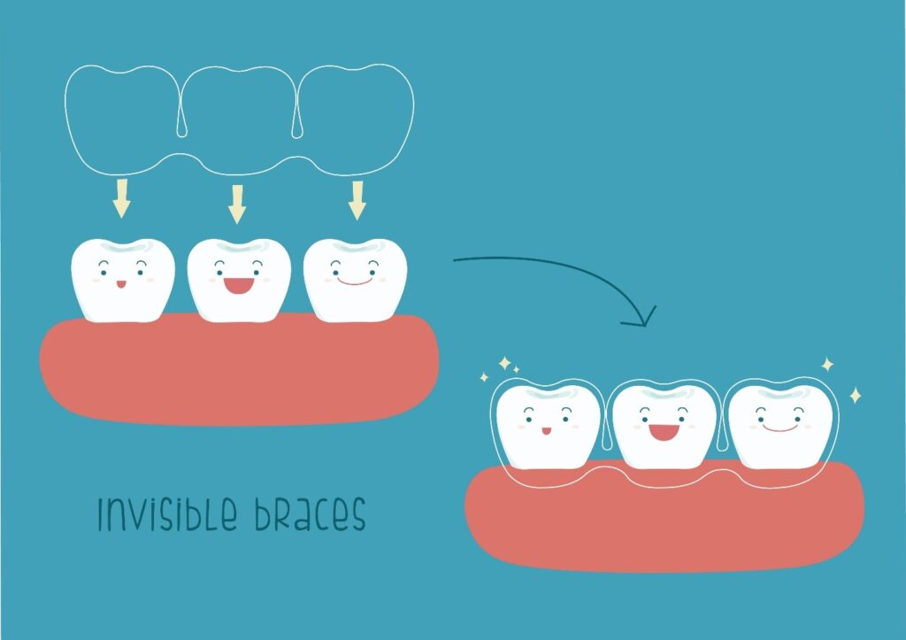 Illustration of teeth covered by invisible braces