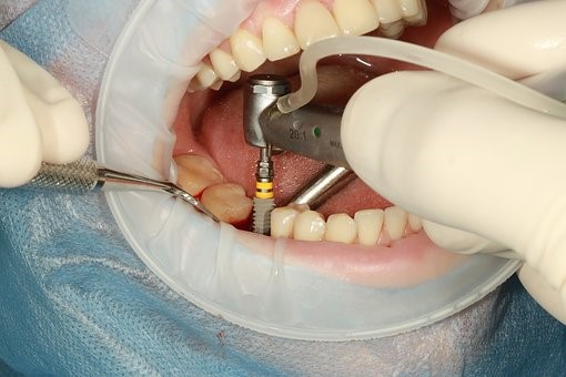 A person getting dental implants at a West Hills Clinic
