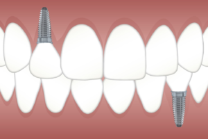 an illustration of dental implants