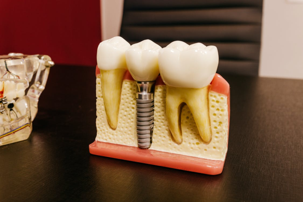 A 3D model of dental implants in a dental clinic in West Hills, CA.