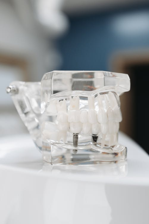  A transparent dental implant model