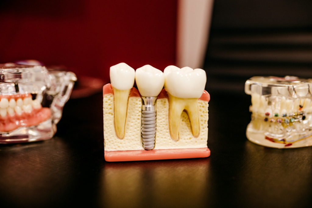 a dental model showing the dental implant in West Hills CA
