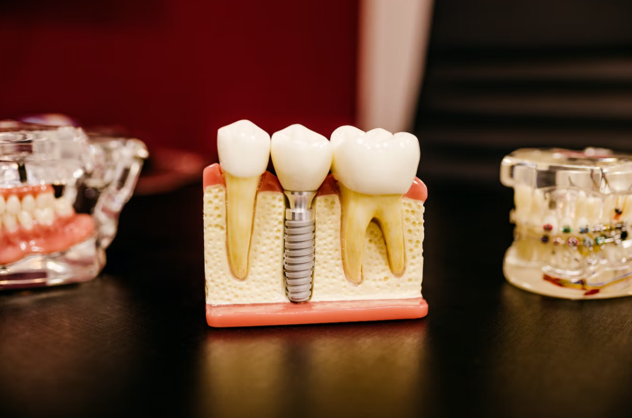A dental implant on a mock-up section of the gum