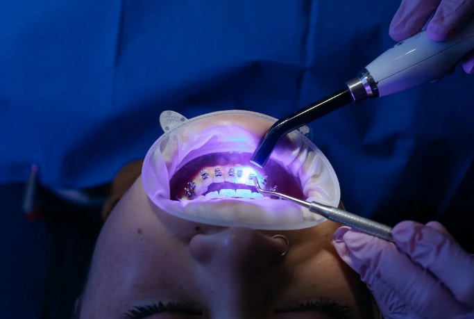 A dentist using a laser beam to treat a patient with braces 