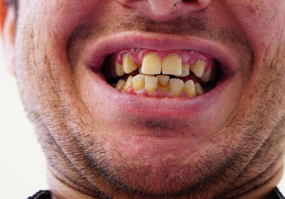 A man suffering from misaligned teeth because of TMJ disorders