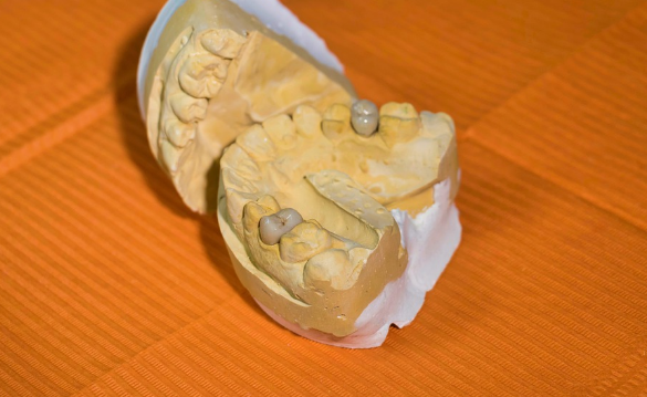 A mockup mandible of the upper and lower jaws for a mouth reconstruction