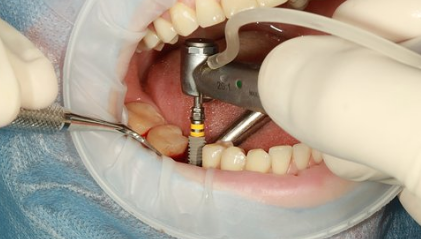 A dental care professional fitting an implant during a surgery