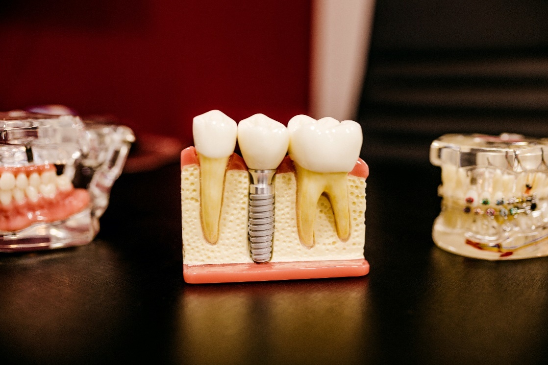 A 3D model of a dental implant