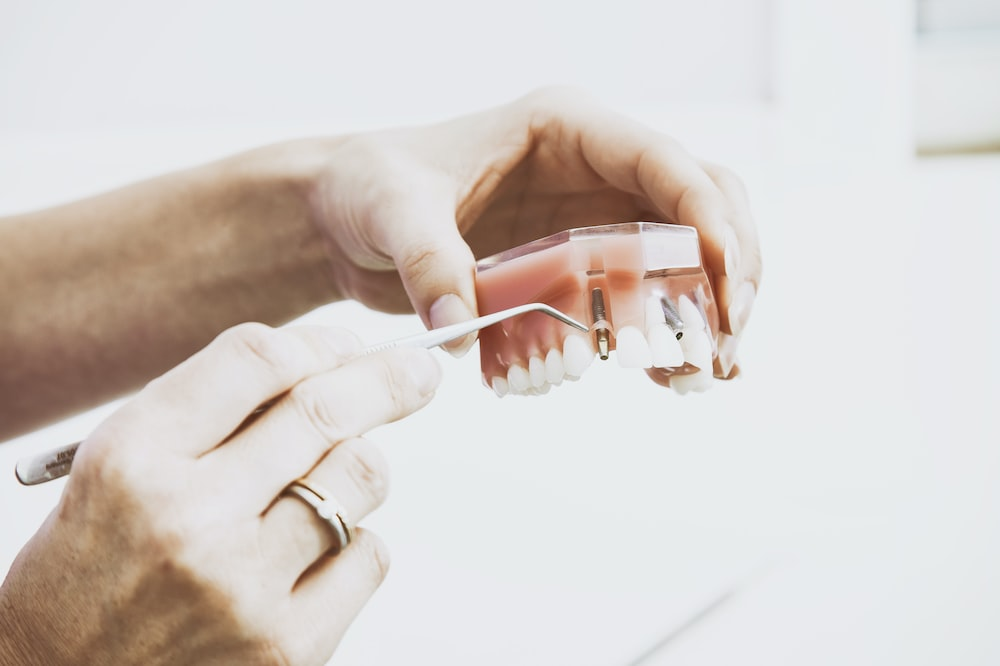 A dentist showing a dental implant’s model