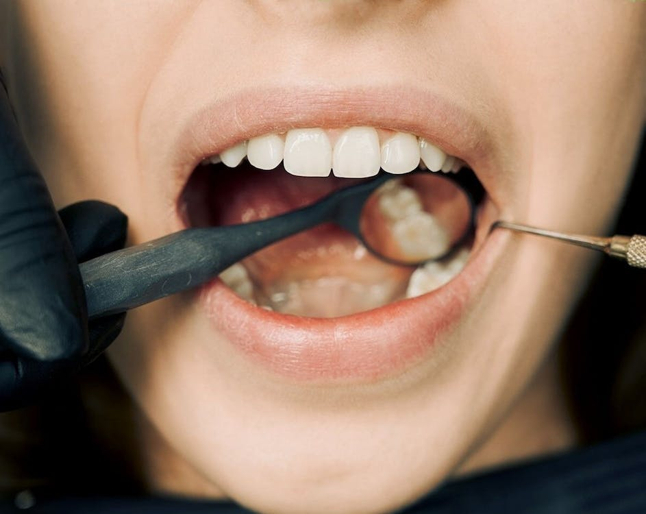 A closeup of a person having a dental cleaning checkup