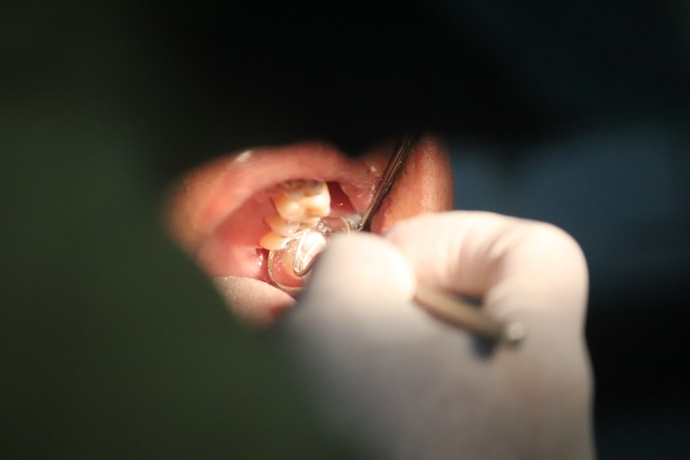 A closeup of a patient having a root canal therapy