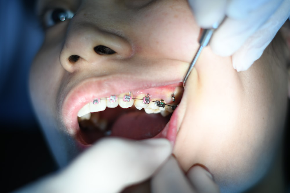 An image of a person with silver braces