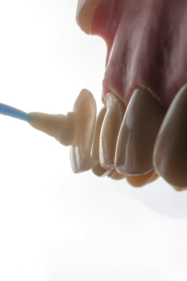 A closeup of a thin shell of dental veneers being applied on a tooth model