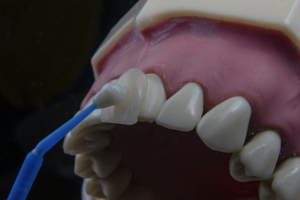 A closeup of dental veneers being applied on a tooth